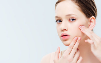 Teenage Acne: 3 steps to take back control of your skin