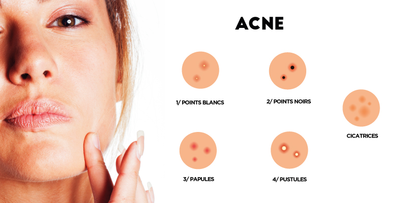 les différents types d'acné