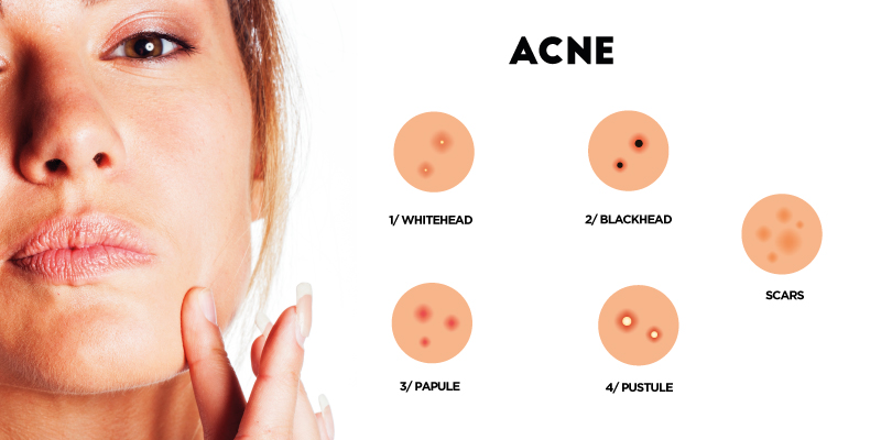  different types of acne 