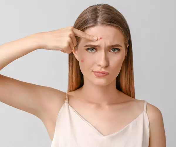 How to Get Rid of Acne: Solutions that Work - EQlib Medispa